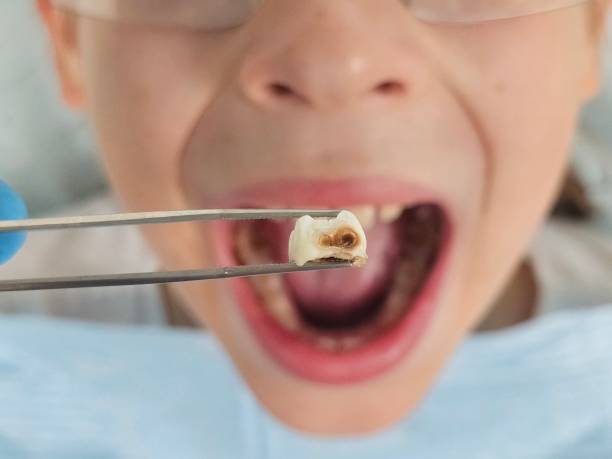Best Urgent Tooth Repair  in Brent, FL